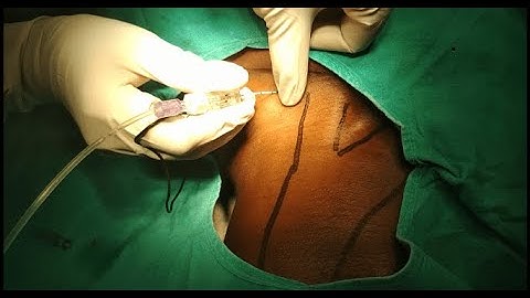 Supraclavicular brachial plexus block - video 2