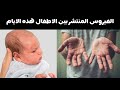 مرض اليد و القدم و الفم عند الاطفال اعراضه و علاجه و افضل طرق الوقاية