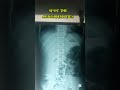 👉 “SPOT the ABNORMALITIES ❌ | Abdomen Erect AP X-ray 🔎” #radiologytech #anatomy #radiology#viral