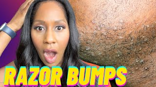 RAZOR BUMPS! How to Get Rid of RAZOR BUMPS FAST! A Doctor Explains