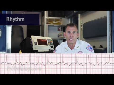 Atrial Fibrillation (ECG Rhythm Interpretation)