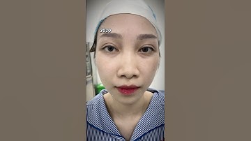 Combo biến hình Nâng mũi + độn cằm 💐🥰 #bacsimanh #nangmui #doncam