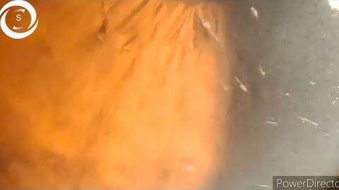 Filamentary keratitis CC 19