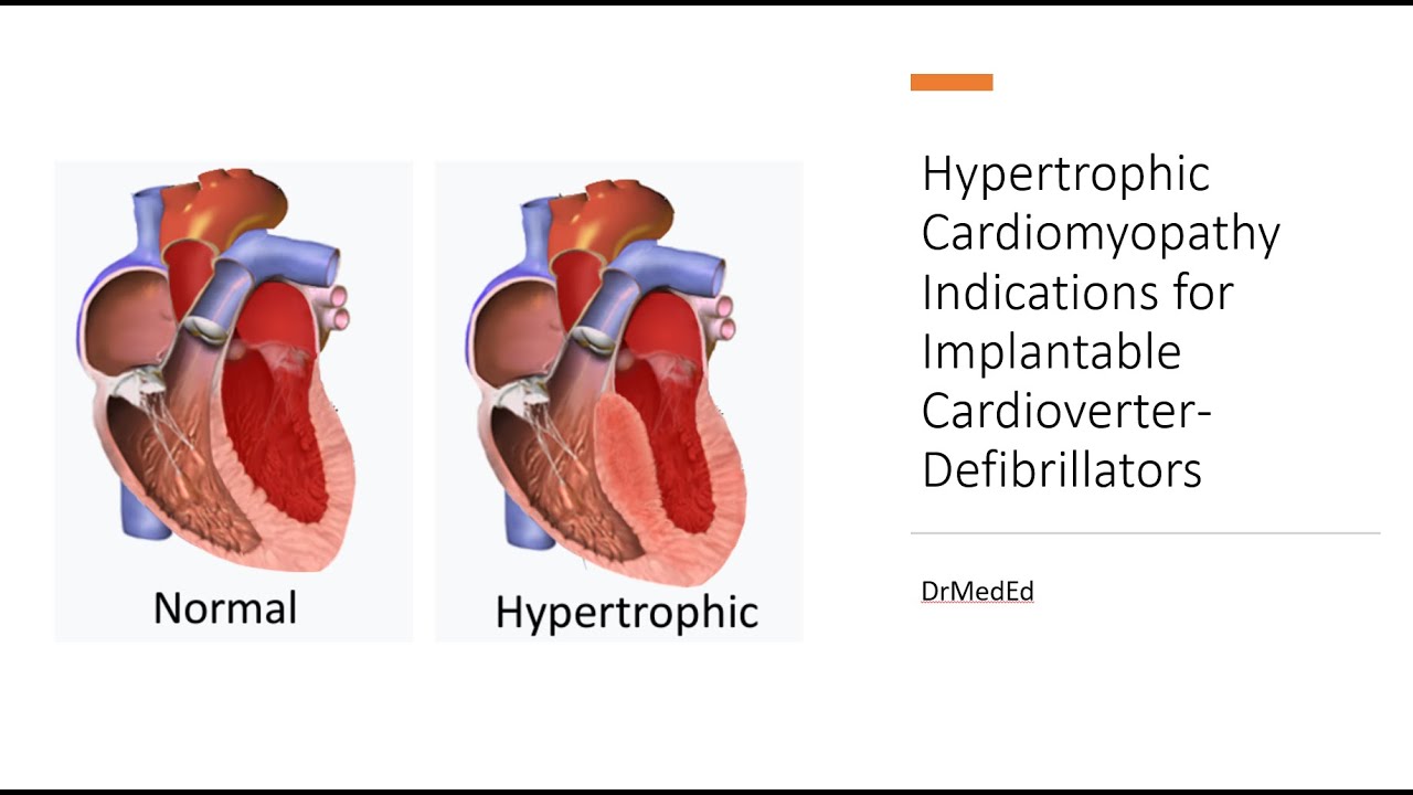 Hypertrophic Cardiomyopathy and Indications for Implantable