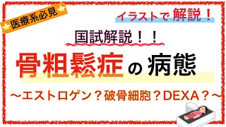 教科書をわかりやすく！「骨粗鬆症の病態」〜原因や検査をわかりやすく解説！〜