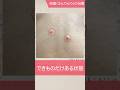 粉瘤の中にはアカや皮脂が詰まっている!? #千里中央花ふさ皮ふ科 #粉瘤 #shorts