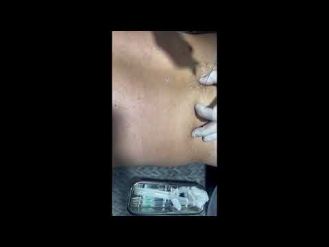 Herniated disc: Therapy with ozone injection & procaine