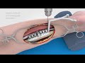 Ips implants forearm reconstruction  patientspecific implants for forearm reconstruction