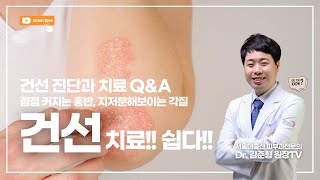 지저분해 보이는 #각질 점점 커지는 #홍반 증상, 피부 #건선 진단부터 치료까지 #울산피부과 #울산건선 #울산아토피 #울산피부과전문의 #서울에이치피부과 #김준형원장 #서울h피부과