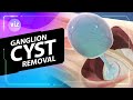 Removing your ganglion cyst (3D Animation)