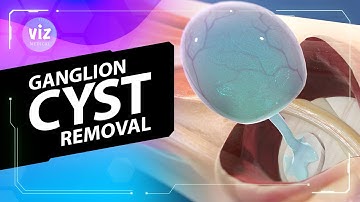 Het verwijderen van uw ganglioncyste (3D-animatie)