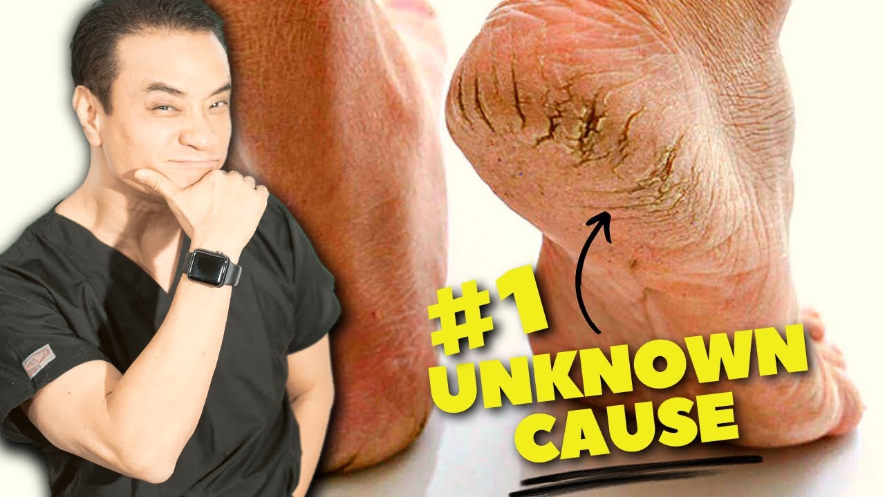 DON'T DO THIS! 7 Surprising Causes Of Cracked Heels YouTube