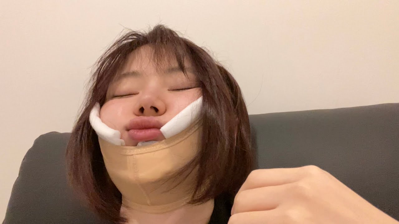 顔の脂肪吸引をしてきました...【丸顔脱却】