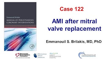 Case 122: PCI Manual - AMI after mitral valve replacement