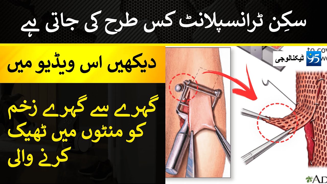 Skin Transplant Technology What is Skin Grafting Technology How Skin Grafting is DONE in