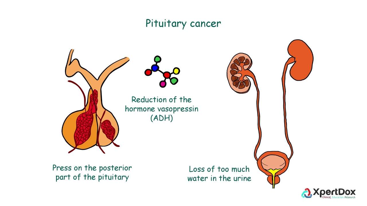 What is Pituitary cancer?