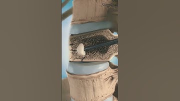 Điều trị xẹp đốt cột sống bằng cách bơm xi măng sinh học | Dr Thùy Dung #drthuydung #shorts