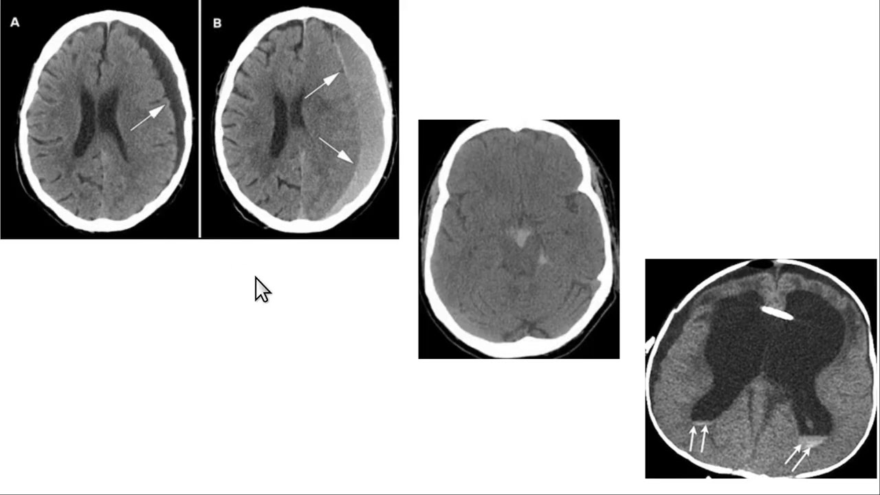 How to Read a Brain CT Scan
