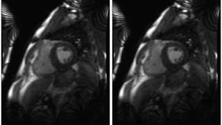 Motion correction (patient A, basal)