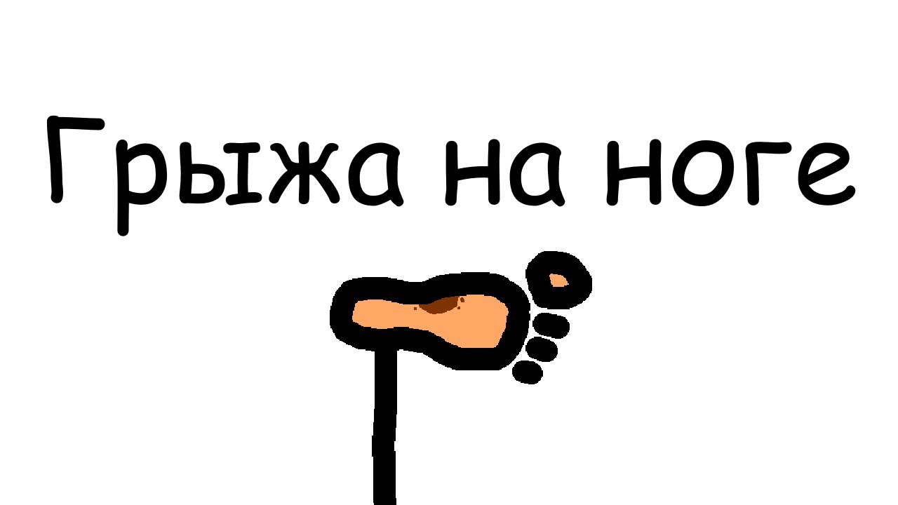 Грыжа на ноге - YouTube