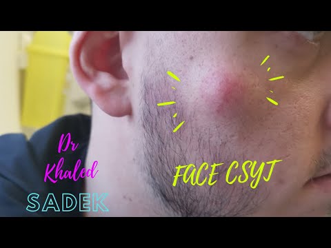 Large Face Cyst Removed. Dr Khaled Sadek LipomaCyst.com