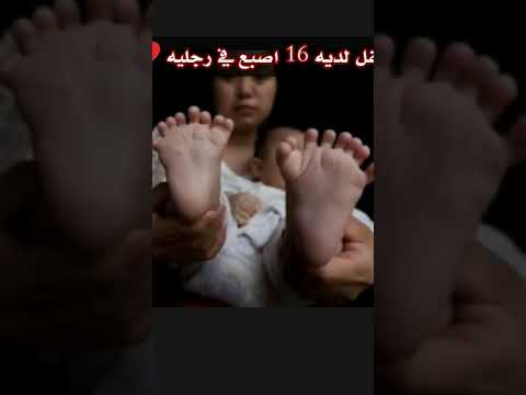 طفل لديه 16 اصبع في رجليه فقط  قصص العراق