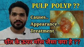 दाँत के बीच में माँस आ गया है ? Pulp polyp,Causes & treatment | Chronic hyperplastic pulpitis