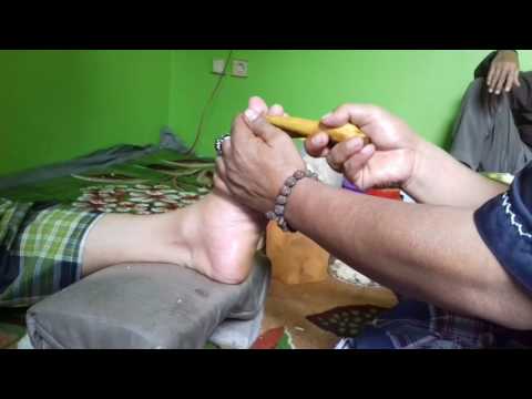 What Saraf Kejepit Pada Kaki