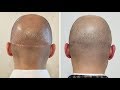 How to Get Rid of Hair Transplant Scars | Scalp Micro USA