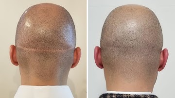 How to Get Rid of Hair Transplant Scars | Scalp Micro USA
