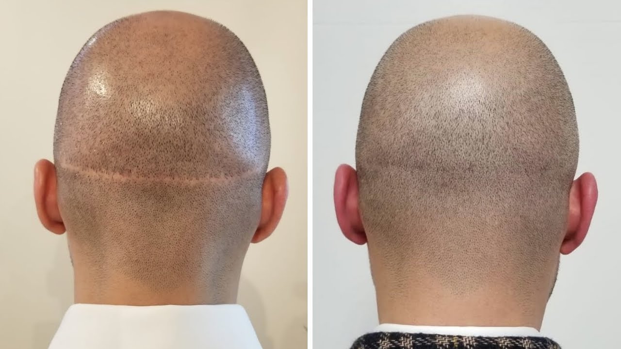 How to Get Rid of Hair Transplant Scars | Scalp Micro USA - YouTube