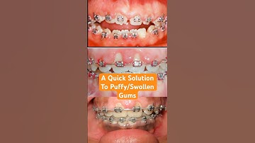 Try this trick when you have puffy gums with your braces! #dentist #shorts #short #braces #dental