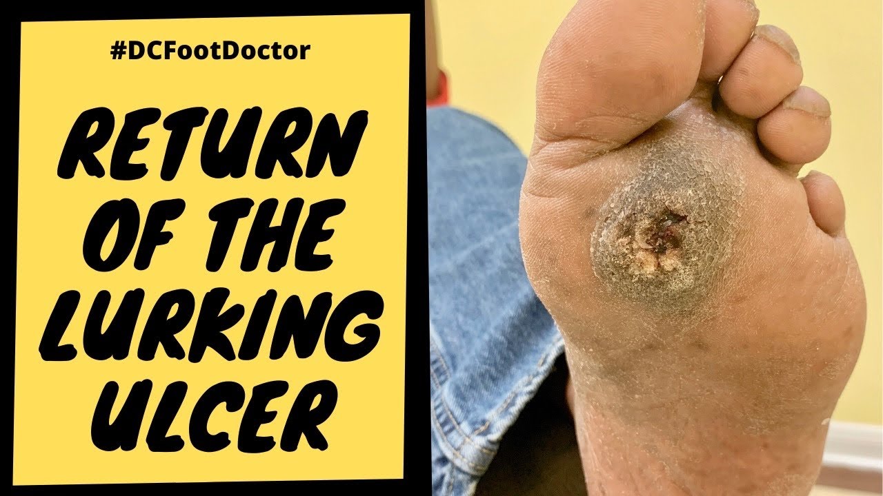 Foot Ulcer: A Diabetic Foot Ulcer Under Thick Callus Returns Foot Ulcer: A Diabetic Foot Ulcer Under Thick Callus Returns