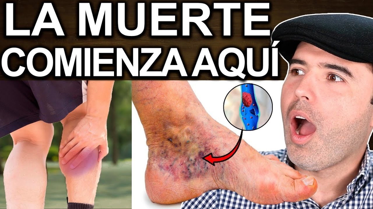 VENAS EN LOS PIES? ALERTA! - Enfermedades Que Las Causan Y Soluciones