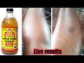 HOW TO: REMOVE DARK SPOTS FROM YOUR LEGS IN 3DAYS,100% WORKING