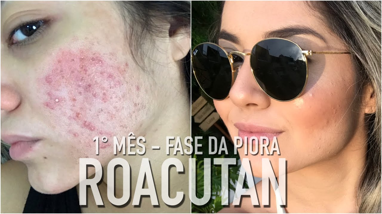 ROACUTAN - 1° MÊS FASE DA PIORA - YouTube