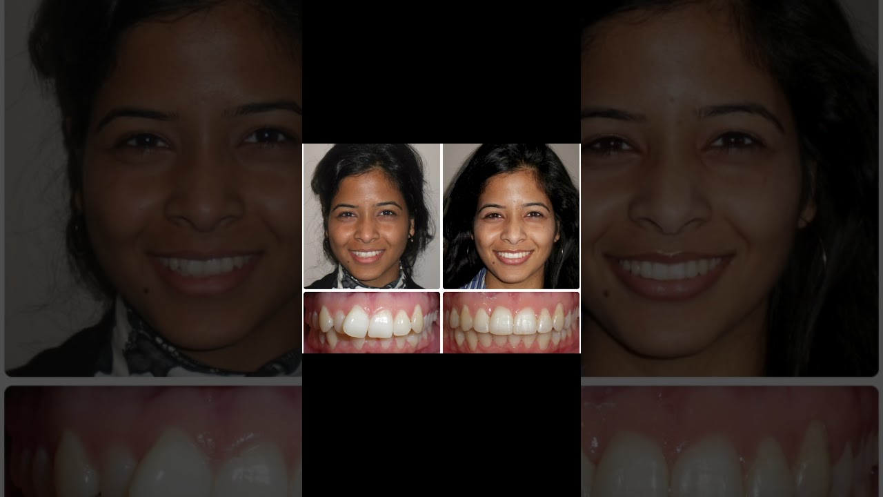 Removal of Premolars in Orthodontic Treatment- one reason to avoid 