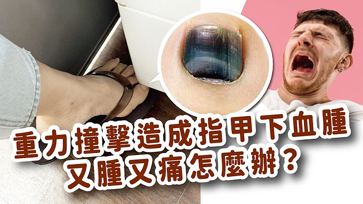 該把指甲拔掉嗎？重力撞擊造成指甲下血腫（Subungual Hematoma）(上集)把握指甲下血腫的「黃金治療期」！ 皮膚專科醫師張英睿