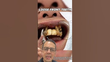 Upper Anterior Teeth Extraction (Bonded Loose Teeth) | In Office to Hands On Dental Training #shorts