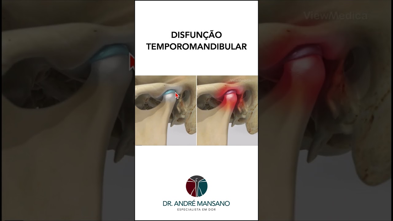 Disfunção na Articulação Temporomandibular: Thaiz Arrabal dá dicas para  diagnóstico