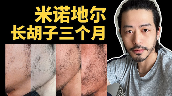 米诺地尔生胡子3个月对比｜可以刮胡子吗？掉皮怎么办？