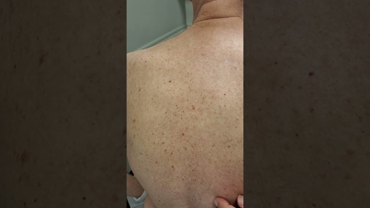 Dr. B Shows what different moles look like on a patient's back #moletypes #moles #dermatologist