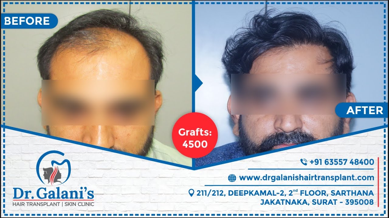 Best Hair Transplant Clinic in Surat | Hair N Images Clinic