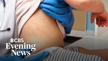 Declining vaccine rates fuel measles outbreak in South Carolina