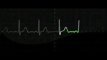 9 hours of Heart rate monitoring EKG grapihics with beeping