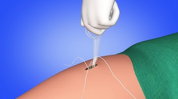 neoClose® AnchorGuard