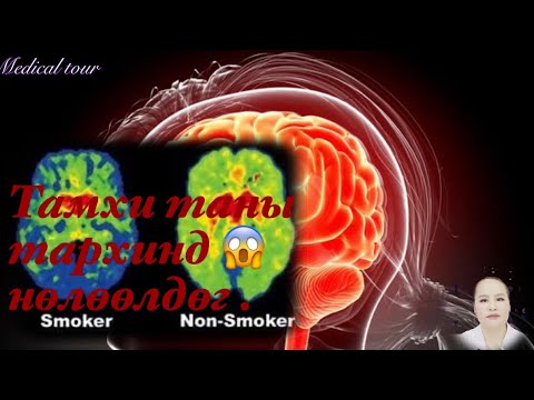 Тамхи Dementia буюу Дэмийрэл өвчний шалтгаан болдог. 😱😱😱