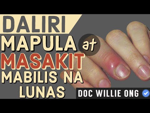 Video: Mga Simpleng Paraan upang Gamutin ang isang Namamaga ng daliri ng paa: 13 Hakbang (na may Mga Larawan)