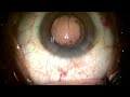 Live Cataract Surgery by Dr Gaurav Luthra