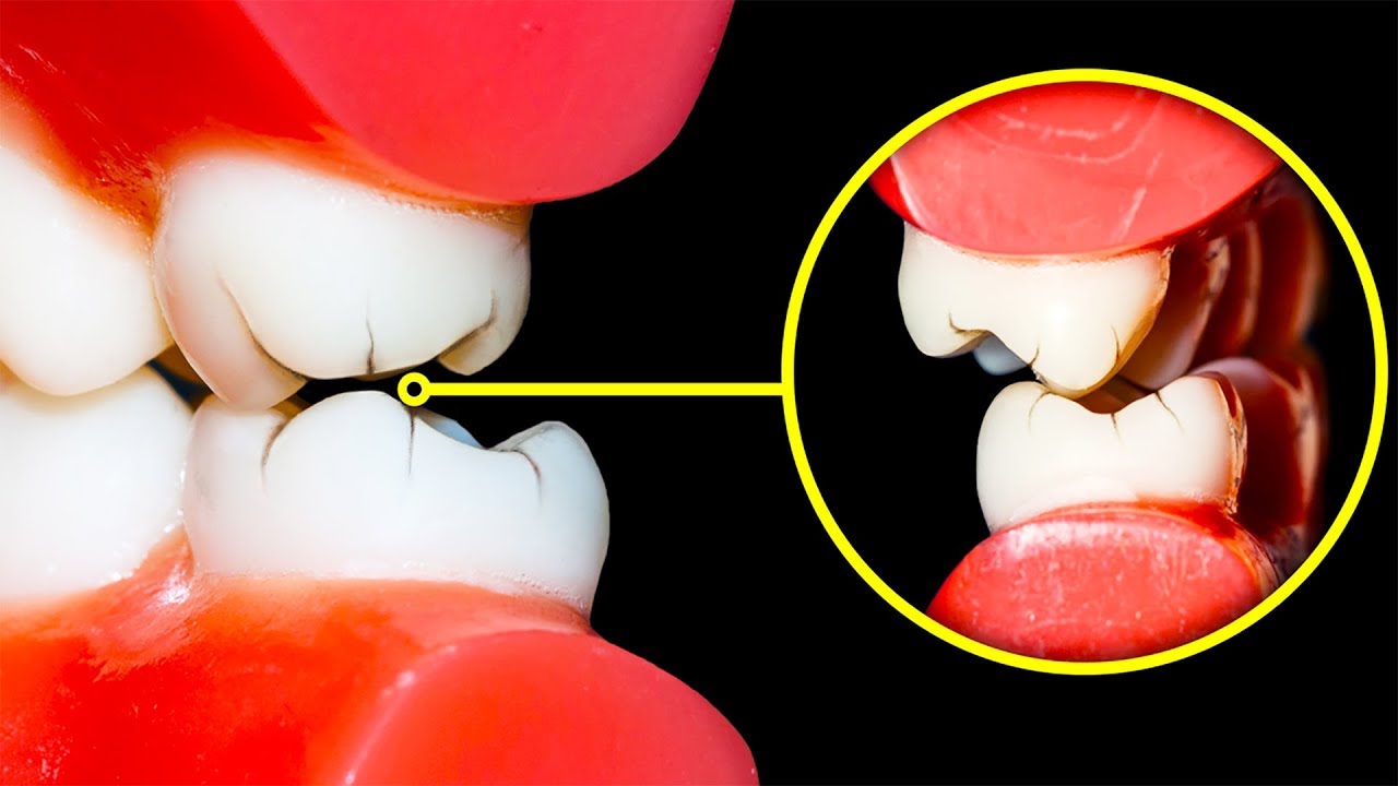 Comment éviter de grincer des dents ? - Dentiste pour Enfants